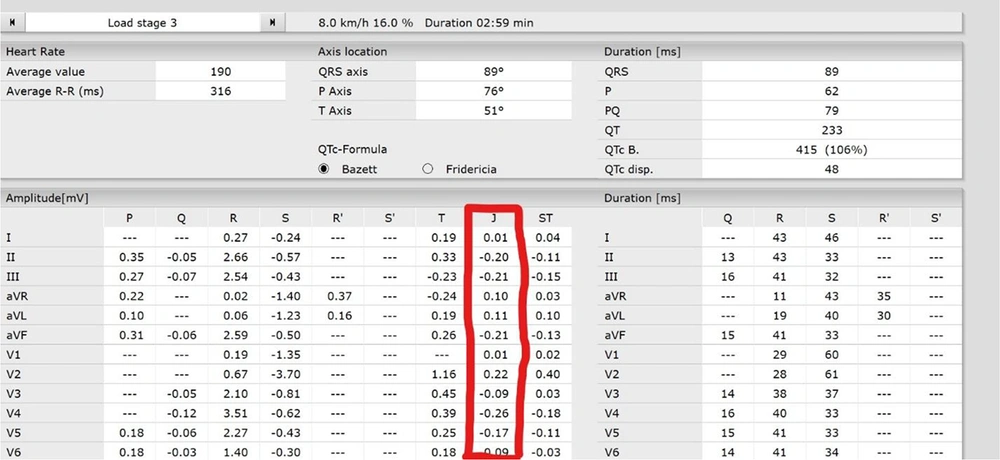 J-point values of all the leads during electrocardiogram (ECG) exercise stress-test J-point values of all the leads during electrocardiogram (ECG) exercise stress-test