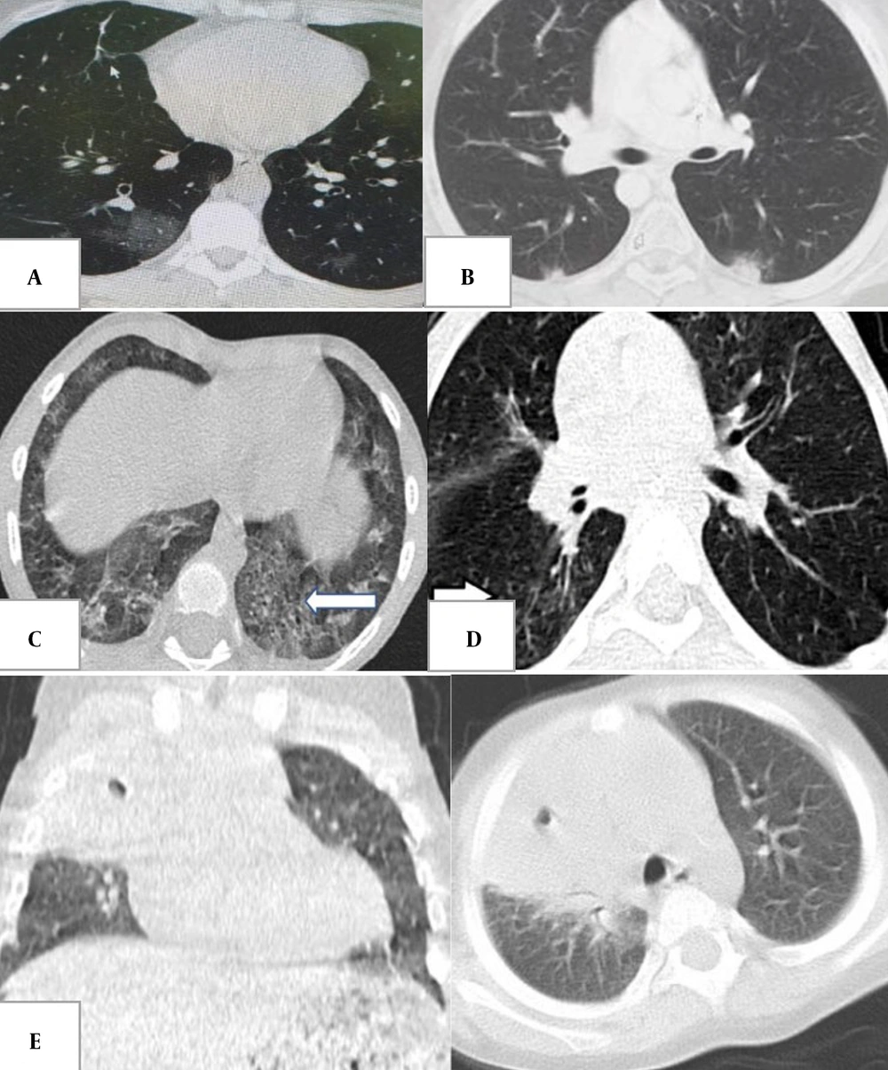 A, bilateral multifocal peripheral and round ground-glass opacities in a 12-year-old boy with fever and cough, typical for coronavirus disease 2019 (COVID-19); B, halo and reverse halo sign in a 12-year-old boy with a history of bone marrow transplantation and persistent fever (typical for COVID-19); C, crazy paving appearance in the left lower lobe (arrow) in a 6-year-old with fever and respiratory distress (typical for COVID-19); D, tree-in-bud appearance in the right lower lobe (arrow) in a 6-year-old boy (atypical for COVID-19); E, consolidation and cavitation in the right upper lobe in a 2-year-old girl with Gaucher disease and congenital neutropenia with respiratory symptoms (atypical for COVID-19). A, bilateral multifocal peripheral and round ground-glass opacities in a 12-year-old boy with fever and cough, typical for coronavirus disease 2019 (COVID-19); B, halo and reverse halo sign in a 12-year-old boy with a history of bone marrow transplantation and persistent fever (typical for COVID-19); C, crazy paving appearance in the left lower lobe (arrow) in a 6-year-old with fever and respiratory distress (typical for COVID-19); D, tree-in-bud appearance in the right lower lobe (arrow) in a 6-year-old boy (atypical for COVID-19); E, consolidation and cavitation in the right upper lobe in a 2-year-old girl with Gaucher disease and congenital neutropenia with respiratory symptoms (atypical for COVID-19).