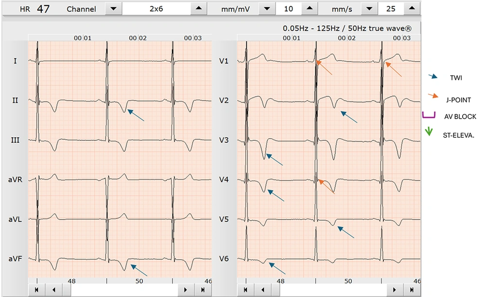 One example of black soccer player electrocardiogram (ECG) pattern with T-wave inversion in II, aVF, V2, V3, V4, V5, V6 of a 26-year-old male (abbreviations: TWI, T-wave inversion; AV, atrioventricular) One example of black soccer player electrocardiogram (ECG) pattern with T-wave inversion in II, aVF, V2, V3, V4, V5, V6 of a 26-year-old male (abbreviations: TWI, T-wave inversion; AV, atrioventricular)