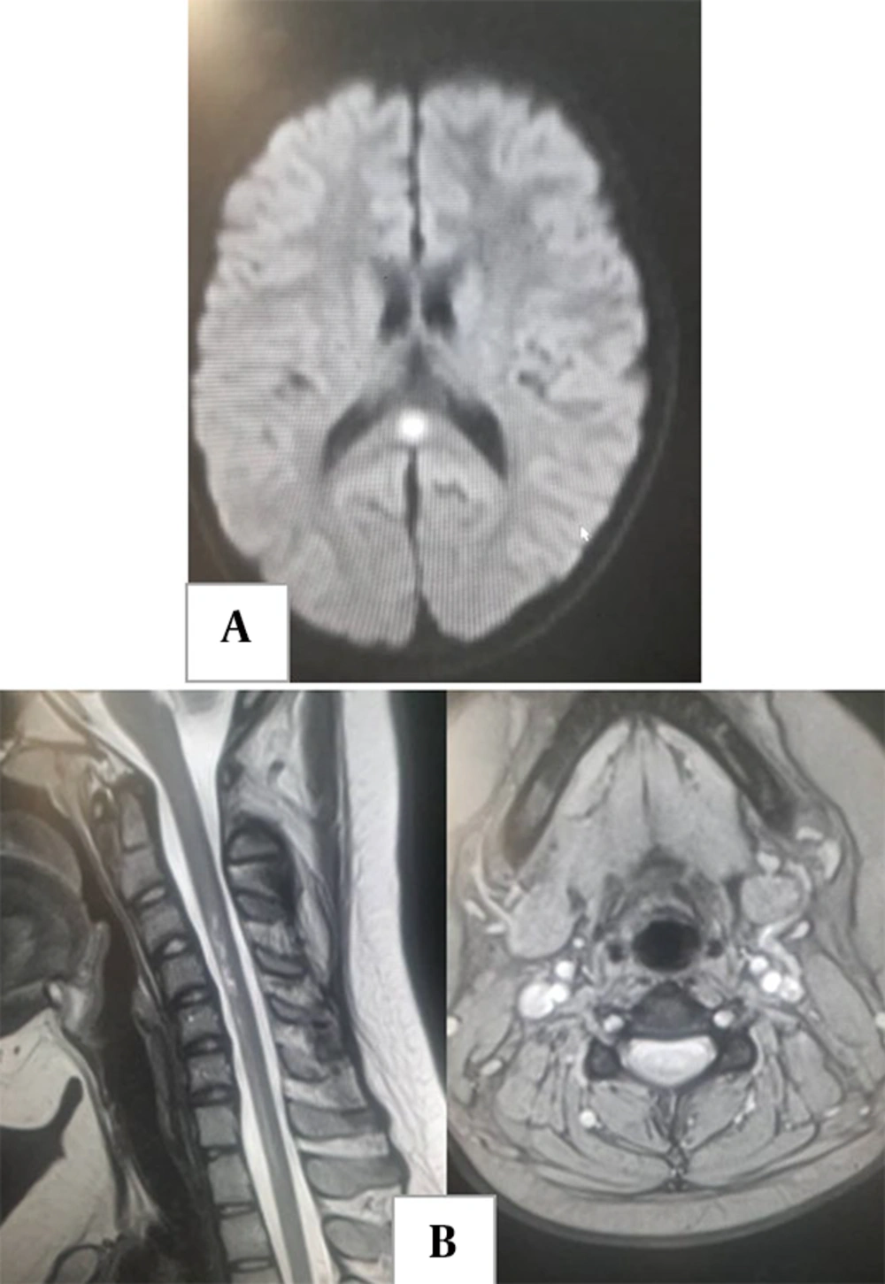 A, cytotoxic lesion of the corpus callosum in a 10-year-old girl with a recent history of coronavirus disease 2019 (COVID-19) who presents with seizure; B, transverse myelitis in a 12-year-old girl with a recent history of COVID-19. A, cytotoxic lesion of the corpus callosum in a 10-year-old girl with a recent history of coronavirus disease 2019 (COVID-19) who presents with seizure; B, transverse myelitis in a 12-year-old girl with a recent history of COVID-19.