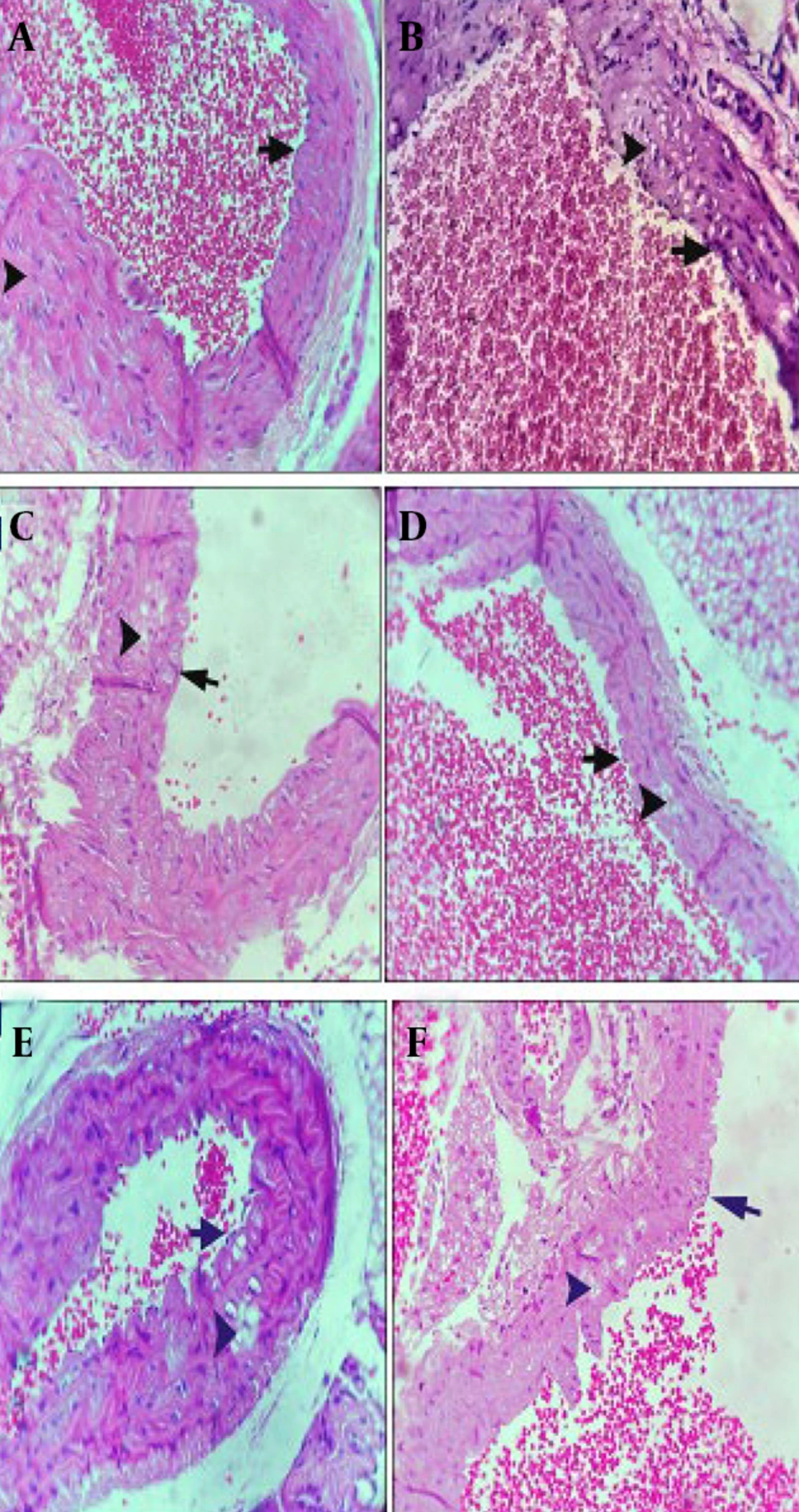 A, the middle layer of the vessel in the healthy control group is indicated by the arrowhead (400X); B, cholesterol plaques (arrowhead) and significant endothelial hyperplasia (arrow) in the AS group (400X). C, the SIM group consists of cholesterol plaques (arrowhead) and mild endothelial hyperplasia (arrow) (400X); D, small cholesterol plaques (arrowheads) in the medial layer of the vessel, healthy endothelium (arrow) (400X); E, in the BBS group, cholesterol plaques (arrowhead) and mild endothelial hyperplasia (arrow) (400X); F, in the BS group, significant cholesterol plaques (arrowhead) and mild endothelial hyperplasia (arrow) (400X). A, the middle layer of the vessel in the healthy control group is indicated by the arrowhead (400X); B, cholesterol plaques (arrowhead) and significant endothelial hyperplasia (arrow) in the AS group (400X). C, the SIM group consists of cholesterol plaques (arrowhead) and mild endothelial hyperplasia (arrow) (400X); D, small cholesterol plaques (arrowheads) in the medial layer of the vessel, healthy endothelium (arrow) (400X); E, in the BBS group, cholesterol plaques (arrowhead) and mild endothelial hyperplasia (arrow) (400X); F, in the BS group, significant cholesterol plaques (arrowhead) and mild endothelial hyperplasia (arrow) (400X).