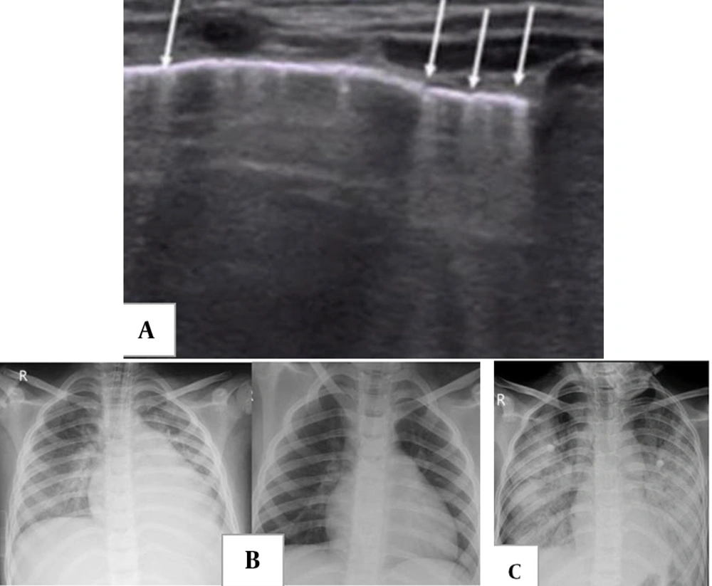 A, two-week-old male full-term newborn with fever and mild respiratory symptoms; lung ultrasound (US) showed multiple vertical B-lines, from: Point-of-care lung US imaging in pediatric coronavirus disease 2019 (COVID-19); B, a 7-year-old boy initially presented with fever and abdominal pain, progressing to respiratory distress and shock; serology was positive for COVID-19. Chest X-ray (CXR) shows features of cardiogenic pulmonary edema, including cardiomegaly, perihilar interstitial thickening and haziness, and mild bilateral pleural effusion. Ten days after treatment and symptom resolution, only cardiomegaly remains due to left heart failure. C, acute respiratory distress syndrome (ARDS) in a 10-year-old boy with a diagnosis of multisystem inflammatory syndrome in children (MIS-C) with acute respiratory distress four weeks after acute COVID-19. Diffuse bilateral airspace consolidation is seen without cardiomegaly. A, two-week-old male full-term newborn with fever and mild respiratory symptoms; lung ultrasound (US) showed multiple vertical B-lines, from: Point-of-care lung US imaging in pediatric coronavirus disease 2019 (COVID-19); B, a 7-year-old boy initially presented with fever and abdominal pain, progressing to respiratory distress and shock; serology was positive for COVID-19. Chest X-ray (CXR) shows features of cardiogenic pulmonary edema, including cardiomegaly, perihilar interstitial thickening and haziness, and mild bilateral pleural effusion. Ten days after treatment and symptom resolution, only cardiomegaly remains due to left heart failure. C, acute respiratory distress syndrome (ARDS) in a 10-year-old boy with a diagnosis of multisystem inflammatory syndrome in children (MIS-C) with acute respiratory distress four weeks after acute COVID-19. Diffuse bilateral airspace consolidation is seen without cardiomegaly.