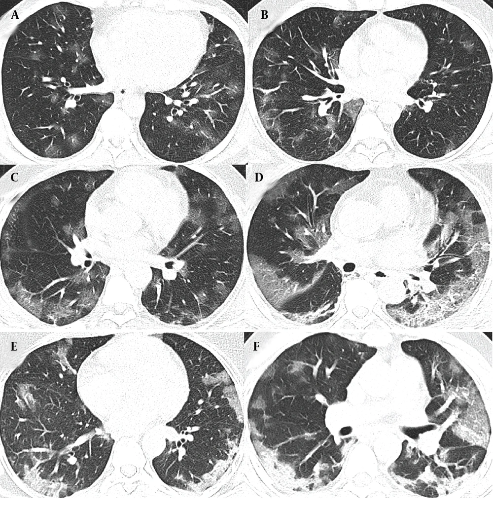 A and B, The radiographic progression of lung involvement in COVID-19 pneumonia, beginning with ground-glass opacity (GGO), an early radiographic finding representing alveolar damage and fluid accumulation; C, As the disease advances, GGO may increase in distribution, exhibiting peripheral predominance; C and D, The crazy paving pattern, characterized by thickened interlobular septa superimposed on ground-glass opacity, indicates deeper lung parenchyma involvement; E and F, Further progression leads to consolidation; where dense opacities obscure the underlying vasculature, signaling severe alveolar damage. A and B, The radiographic progression of lung involvement in COVID-19 pneumonia, beginning with ground-glass opacity (GGO), an early radiographic finding representing alveolar damage and fluid accumulation; C, As the disease advances, GGO may increase in distribution, exhibiting peripheral predominance; C and D, The crazy paving pattern, characterized by thickened interlobular septa superimposed on ground-glass opacity, indicates deeper lung parenchyma involvement; E and F, Further progression leads to consolidation; where dense opacities obscure the underlying vasculature, signaling severe alveolar damage.