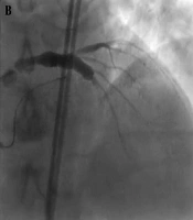 Int Cardiovasc Res J